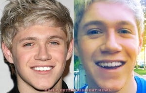 Niall Horan before and after braces - DailyEntertainmentNews.com